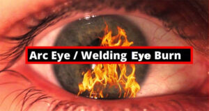Welding eyes burn